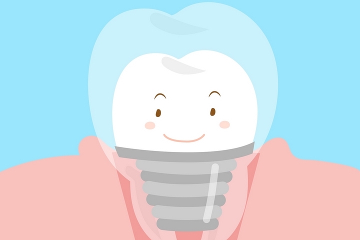 The 5 Secret Tricks to Keep Your Dental Implants Healthy