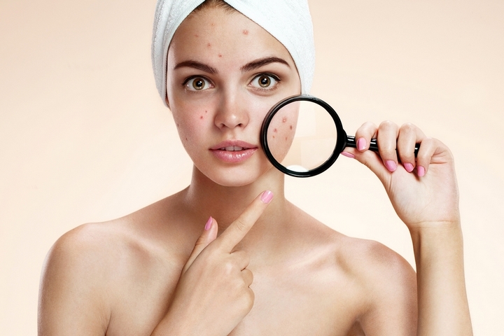 The Top 6 Adult Acne Causes in Men and Women